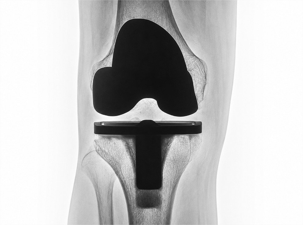 secuelas de una artroscopia de rodilla